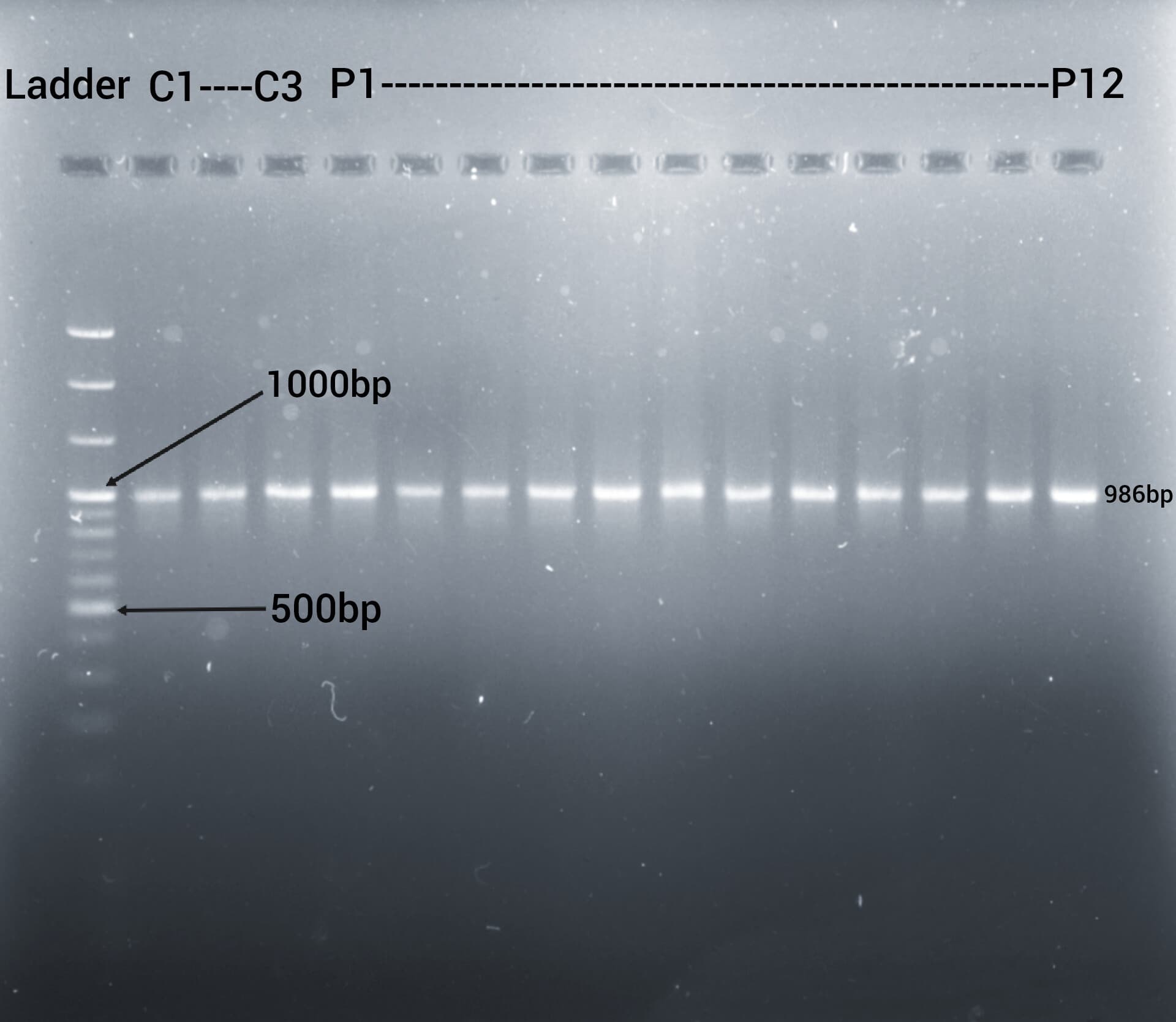 Agarose gel electrophoresis showing a 100 bp ladder followed by fifteen lanes - three controls (C1–C3) and twelve patients (P1–P12) - each with a single clean band at 986 bp, between the 500 bp and 1000 bp ladder markers.